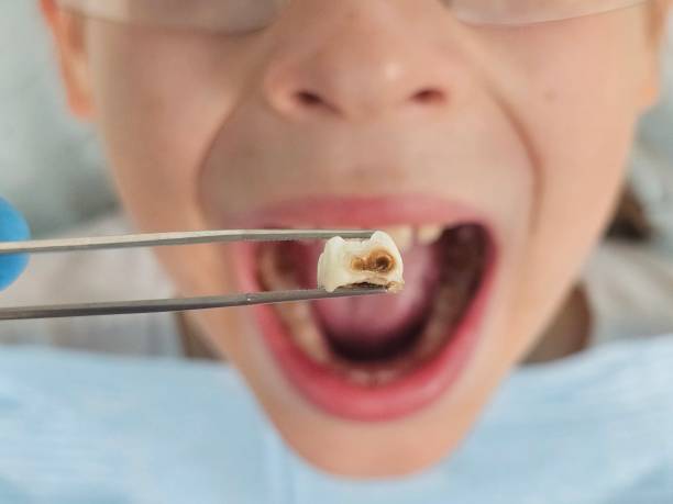 Best Emergency Treatment for Toothache in Haughton, LA